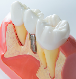 Dental Implants & Periodontal Surgery - Michigan OMS in Metro Detroit - procedures-1